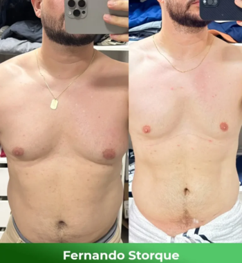Fernando-Storque-Antes-e-depois-1-768x864-1.webp